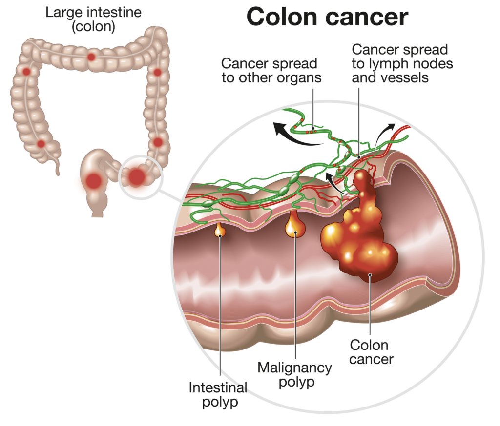 Understanding Colon Cancer - TRULY HEAL